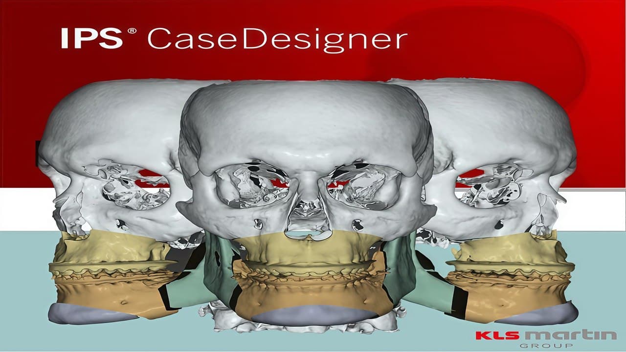 KLS Martin IPS CaseDesigner - Dental: Software Profesional