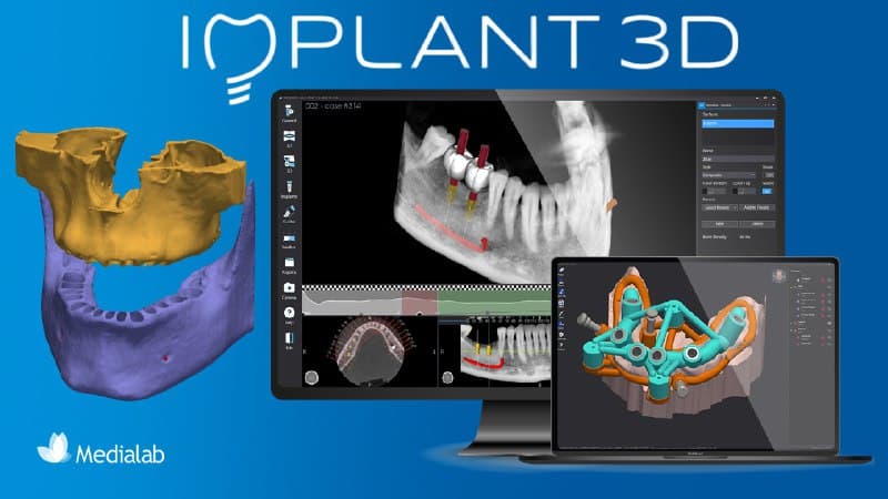 Media Lab Implant 3D 9.3.0 - Dental: Software Profesional